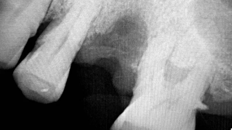 Ridge Preservation with NOVAMag® SHIELD and collacone® in a periodontally compromised patient