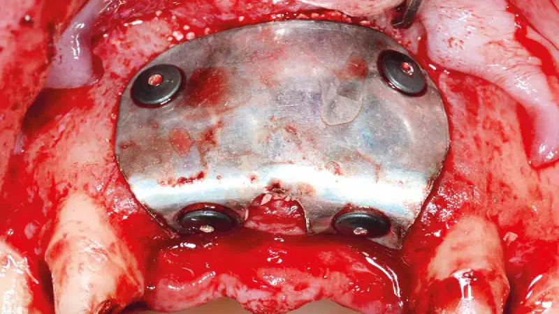 Horizontal Ridge Augmentation in the Anterior Maxilla Using NOVAMag® membrane and cerabone®