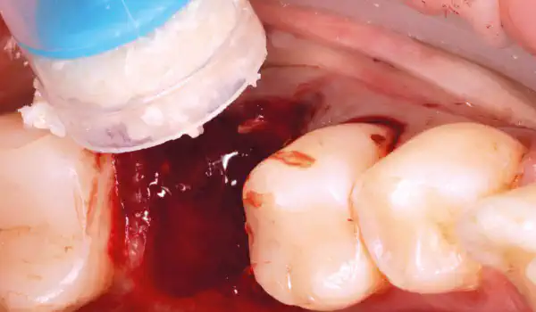 Image for case Socket preservation with a short re-entry time using maxgraft®, cerabone® and mucoderm®