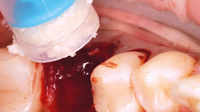 Socket preservation with a short re-entry time using maxgraft®, cerabone® and mucoderm®