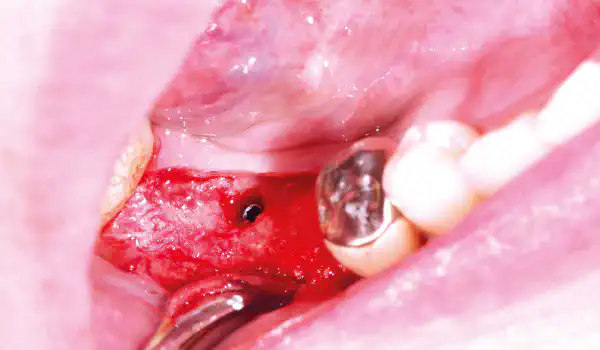 Image for case Implant placement and bone defect augmentation in the posterior mandible