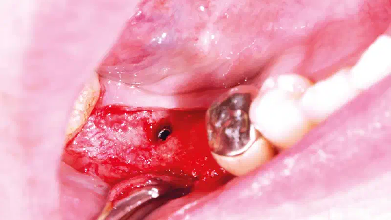 Implant placement and bone defect augmentation in the posterior mandible