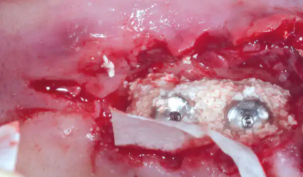 Image for case Bone regeneration at two peri-implantitis affected implants using cerabone® +HyA and Jason® membrane