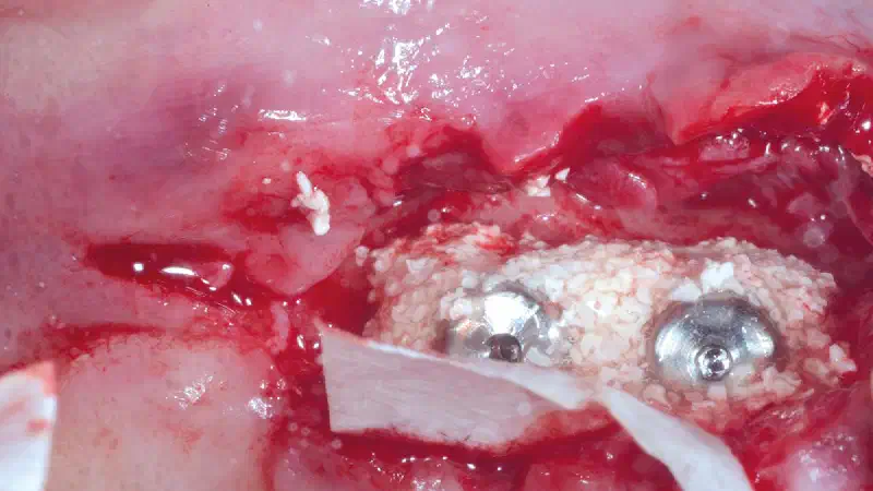 Bone regeneration at two peri-implantitis affected implants using cerabone® +HyA and Jason® membrane