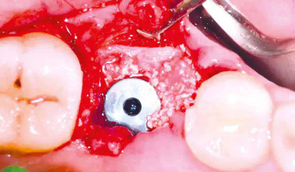 Image for case Immediate implantation in the posterior mandible