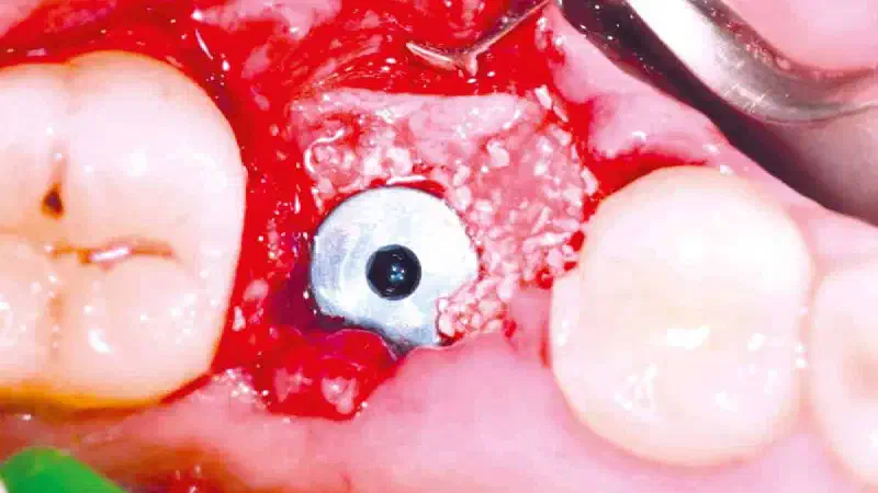 Immediate implantation in the posterior mandible