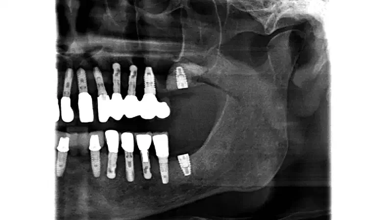 Lateral sinus floor augmentation using cerabone® +HyA