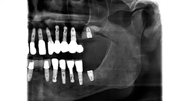 Image for case Lateral sinus floor augmentation using cerabone® +HyA