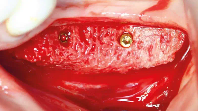 Ridge augmentation in the mandible with maxgraft® bonebuilder in a free-end situation