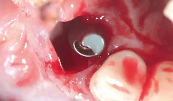 Image for case Immediate implantation with the Shield technique in the aesthetic zone