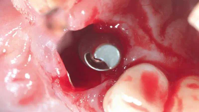 Immediate implantation with the Shield technique in the aesthetic zone