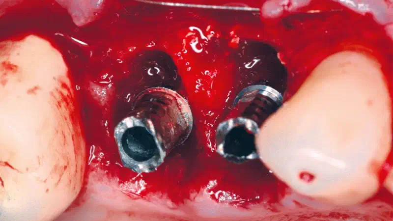 Initial findings from a Shield Technique study in collaboration with the Faculty of Dental Medicine, Lebanese University Lebanon University