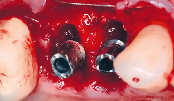 Image for case Initial findings from a Shield Technique study in collaboration with the Faculty of Dental Medicine, Lebanese University Lebanon University