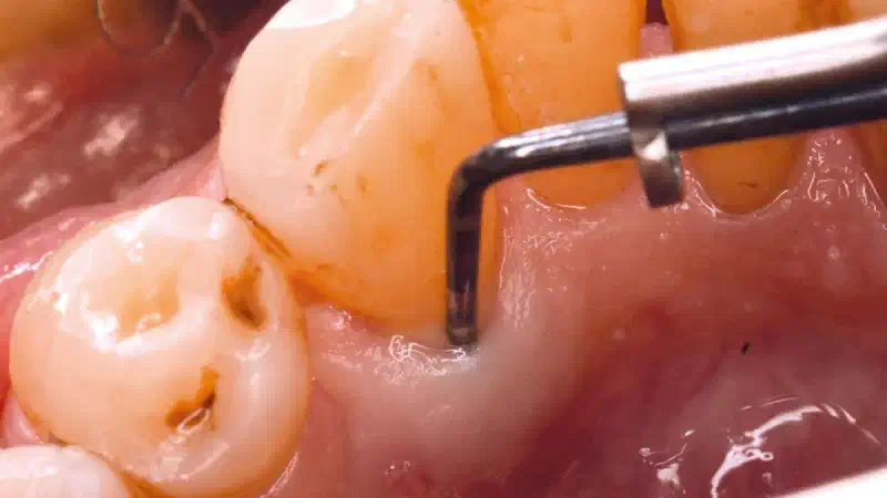 Regeneration of a severe infra-osseous defect with cerabone® +HyA and mucoderm®