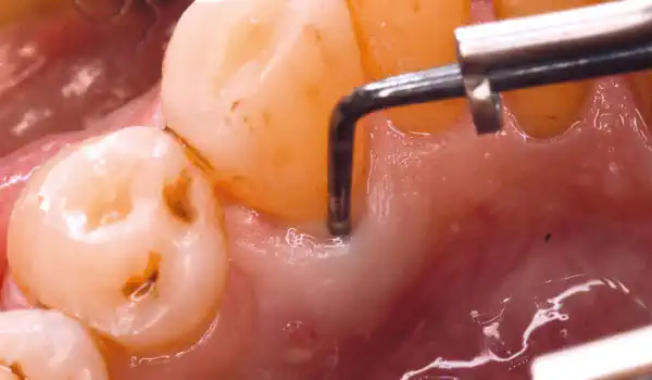 Image for case Regeneration of a severe infra-osseous defect with cerabone® +HyA and mucoderm®