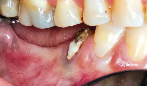Image for case Long-term outcomes of horizontal ridge augmentation with GBR using cerabone® – A 6.5-year follow-up case
