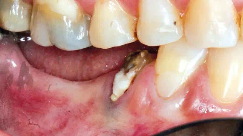 Long-term outcomes of horizontal ridge augmentation with GBR using cerabone® – A 6.5-year follow-up case