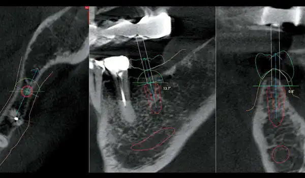Image for case GBR with cerabone® and Jason® membrane using the Sausage Technique