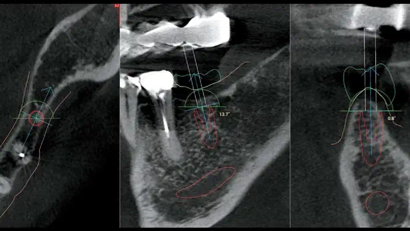 GBR with cerabone® and Jason® membrane using the Sausage Technique
