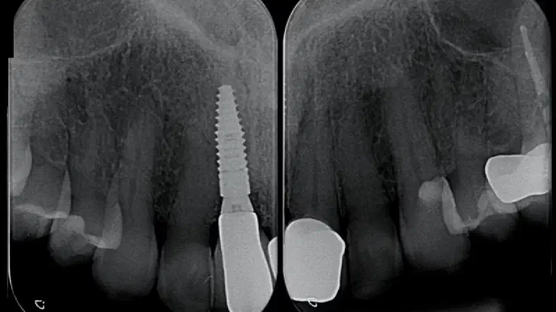 Tooth extraction with immediate implant placement (incisor region)