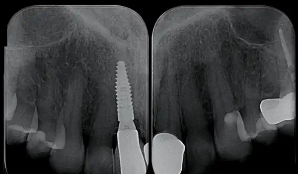 Image for case Tooth extraction with immediate implant placement (incisor region)