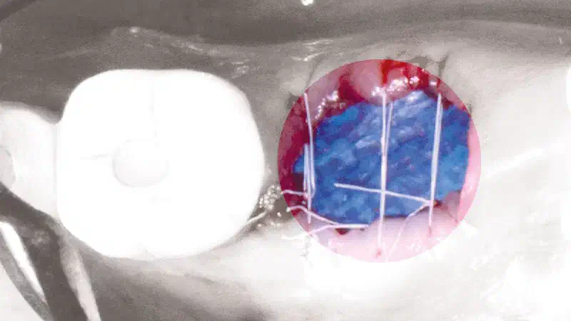 Open healing socket preservation in the posterior mandible using permamem® and maxgraft®