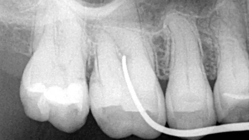permamem® and maxgraft® used for alveolar socket preservation following removal of a periodontally involved tooth
