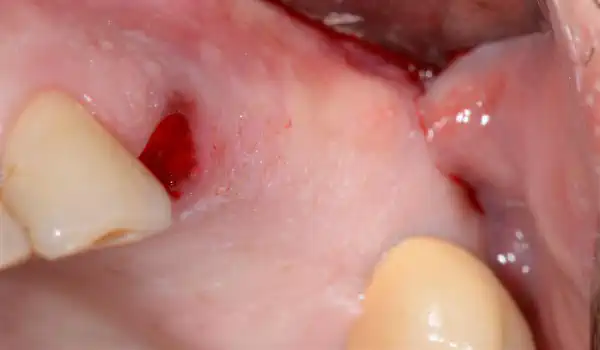 Image for case Two stage sinus lift with cerabone® and Jason® membrane & collafleece®