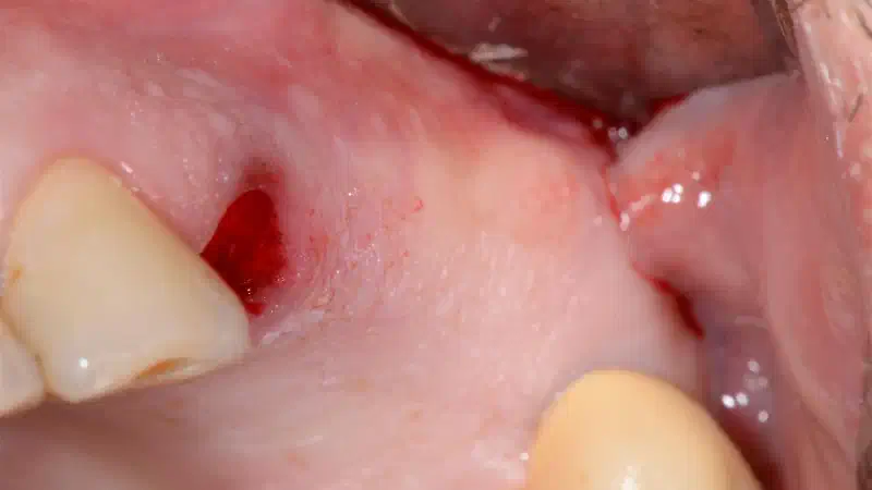 Two stage sinus lift with cerabone® and Jason® membrane & collafleece®