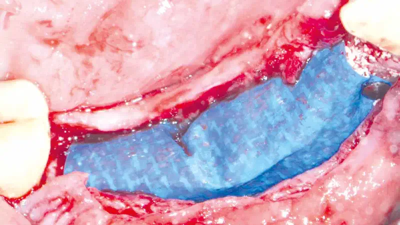 Complete restoration of a patient with advanced periimplantitis