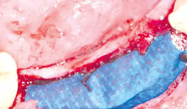 Image for case Complete restoration of a patient with advanced periimplantitis
