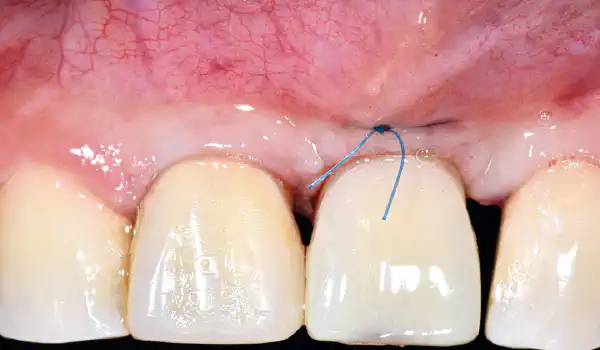 Image for case GBR and simultaneous implant placement with cerabone® +HyA, autologous bone & Jason® membrane in the anterior maxilla after failed first surgery