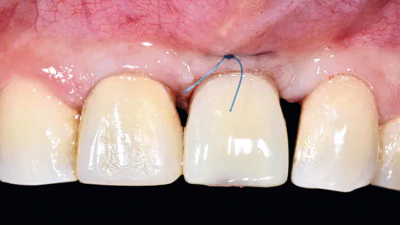 GBR and simultaneous implant placement with cerabone® +HyA, autologous bone & Jason® membrane in the anterior maxilla after failed first surgery