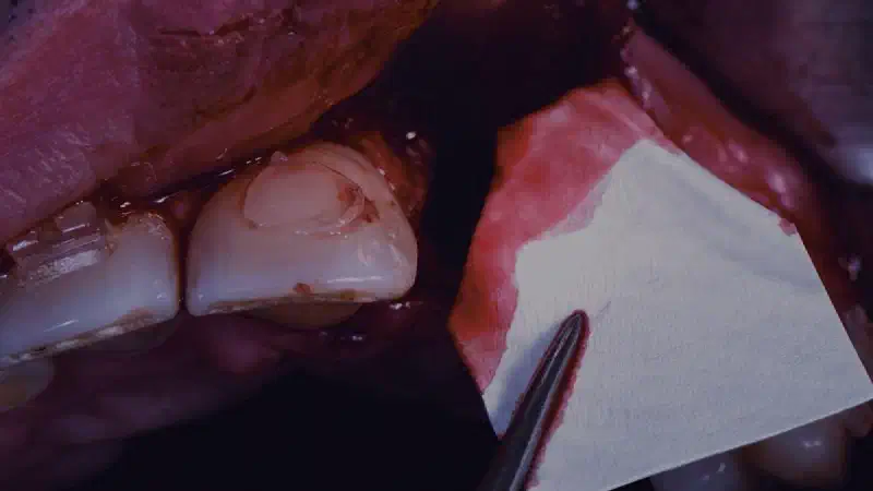 Bone regeneration after implant removal using cerabone® and Jason® membrane
