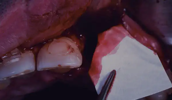 Image for case Bone regeneration after implant removal using cerabone® and Jason® membrane