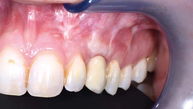 Horizontal GBR with cerabone® block – 8-year follow-up