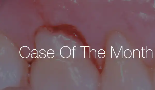 Image for case Posterior socket preservation using maxgraft® and permamem® – a 2-year follow up