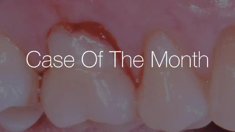 Posterior socket preservation using maxgraft® and permamem® – a 2-year follow up