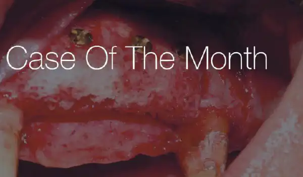 Image for case Reconstruction of Anterior Maxilla with maxgraft® bonebuilder – a 5 years follow-up