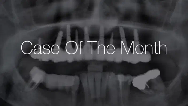 Horizontal ridge augmentation with maxgraft® cortico, cerabone® and collprotect® membrane