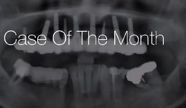 Image for case Horizontal ridge augmentation with maxgraft® cortico, cerabone® and collprotect® membrane