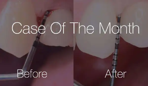 Image for case Reconstructive peri-implantitis treatment using photodynamic therapy and cerabone® +HyA