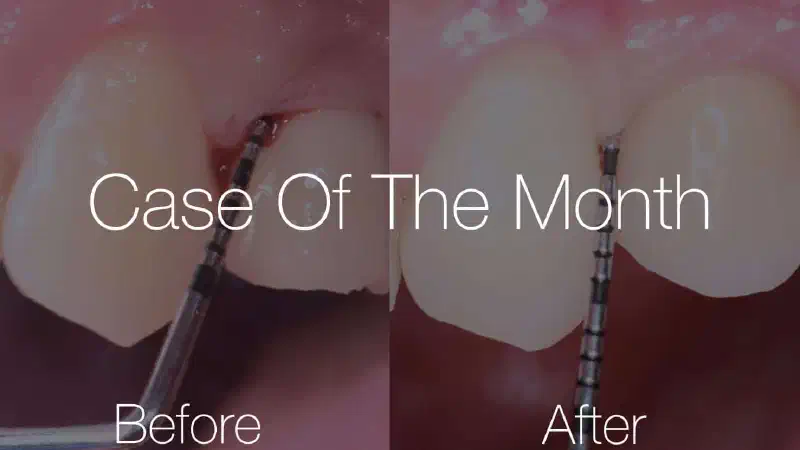 Reconstructive peri-implantitis treatment using photodynamic therapy and cerabone® +HyA