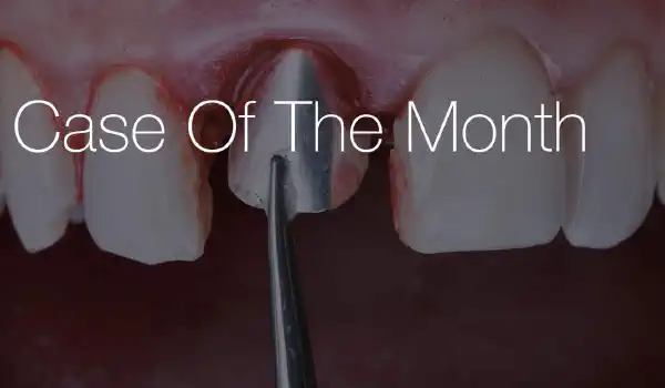 Image for case NOVAMag® SHIELD Technique with Immediate Implant and Immediate Temporization