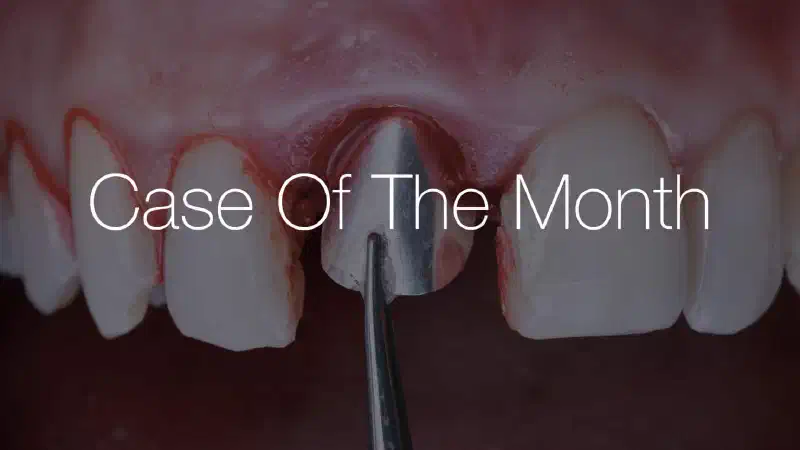 NOVAMag® SHIELD Technique with Immediate Implant and Immediate Temporization
