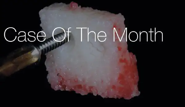 Image for case Reconstruction of maxillary ridge with maxgraft® block