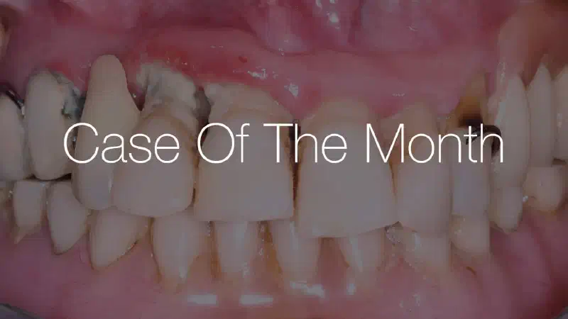 Full jaw reconstruction with NOVAMag® membrane