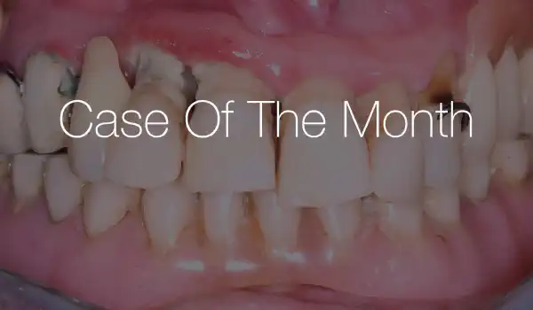 Image for case Full jaw reconstruction with NOVAMag® membrane