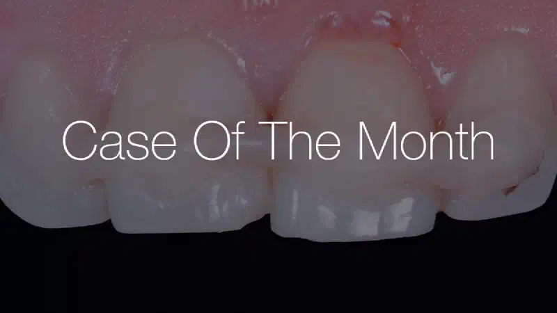 Treatment of a double root fracture in the aesthetic zone with cerabone®