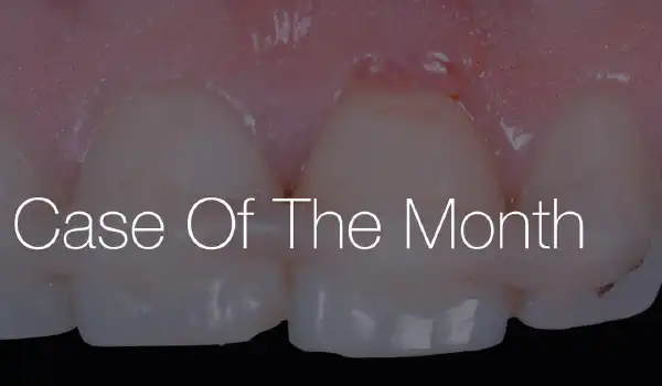 Image for case Treatment of a double root fracture in the aesthetic zone with cerabone®